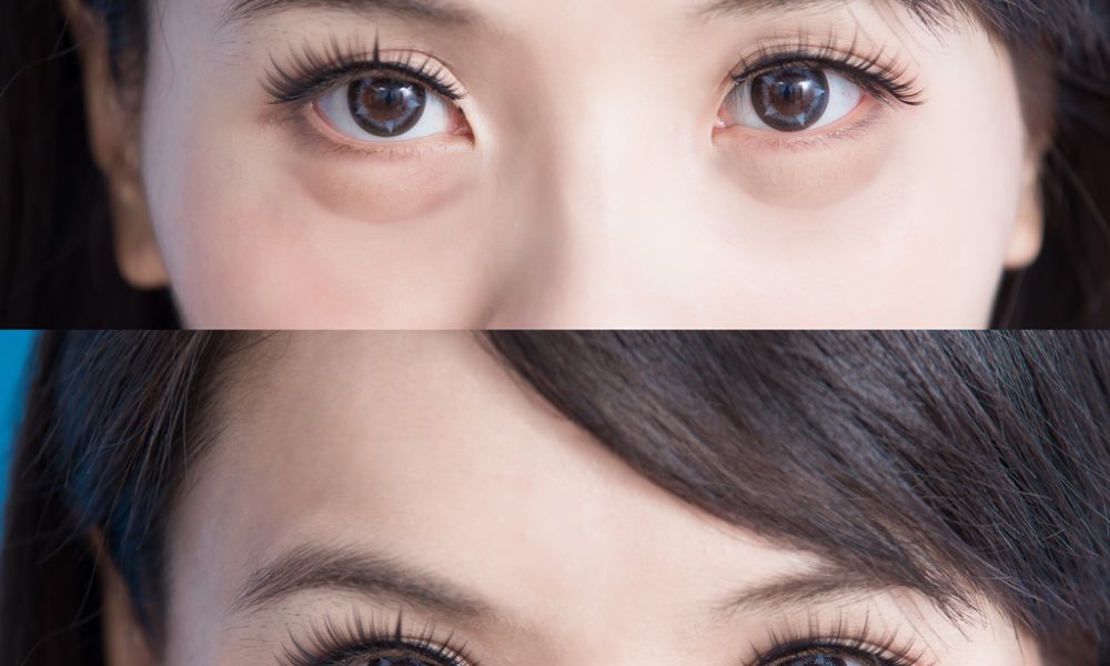 eye bag removal surgery