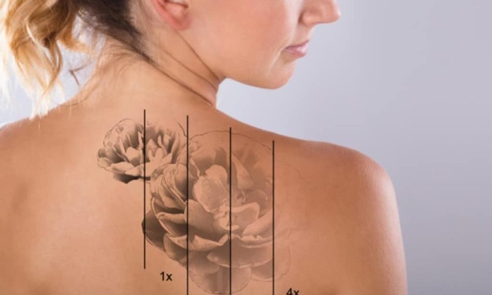 Trying to Remove a Tattoo at Home Can Do More Harm Than Good