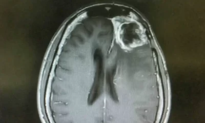 Glioblastoma