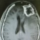Glioblastoma