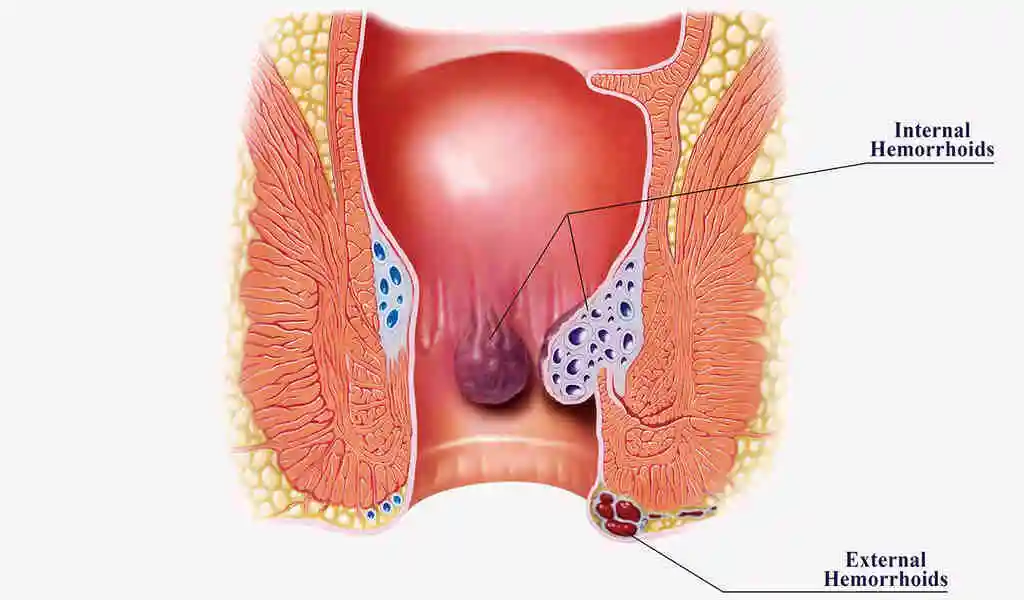 hemorrhoids last
