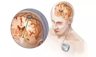 Neurostimulation Devices