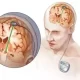 Neurostimulation Devices