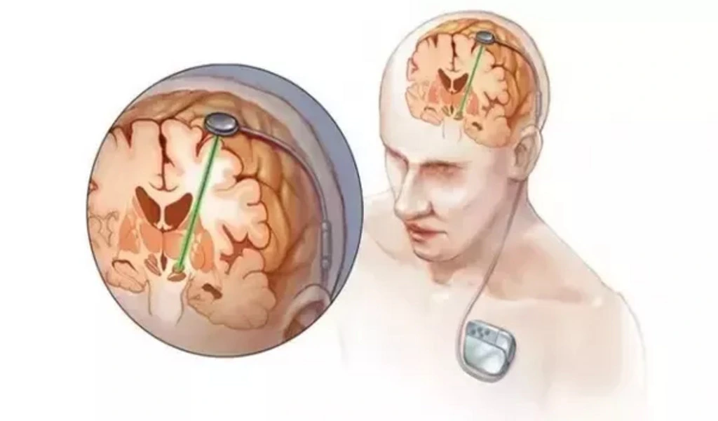 Neurostimulation Devices