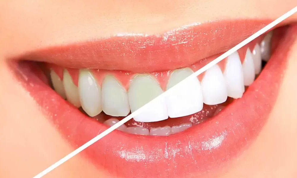 Teeth whitening