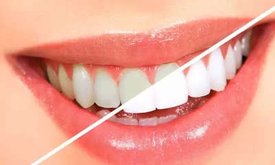 Teeth whitening