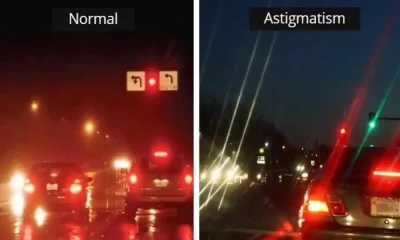 astigmatism