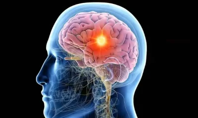 Epilepsy