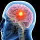 Epilepsy