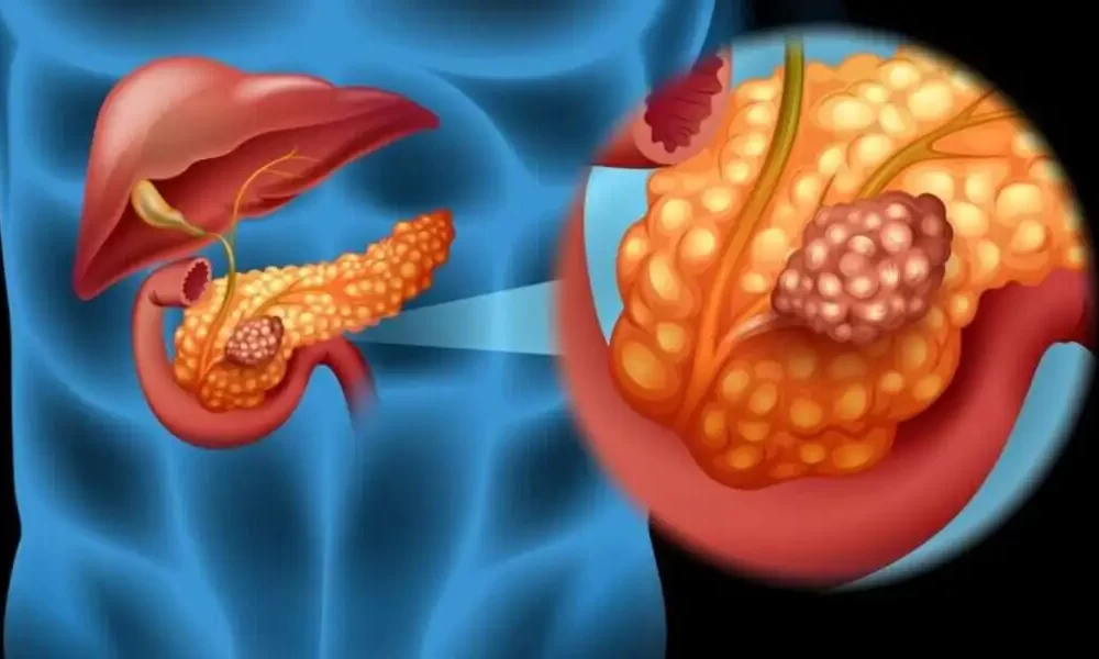 Pancreatic Cancer