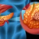 Pancreatic Cancer