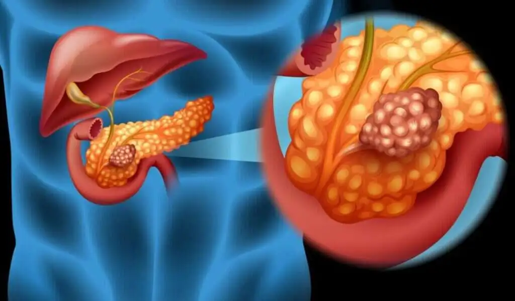 Pancreatic Cancer