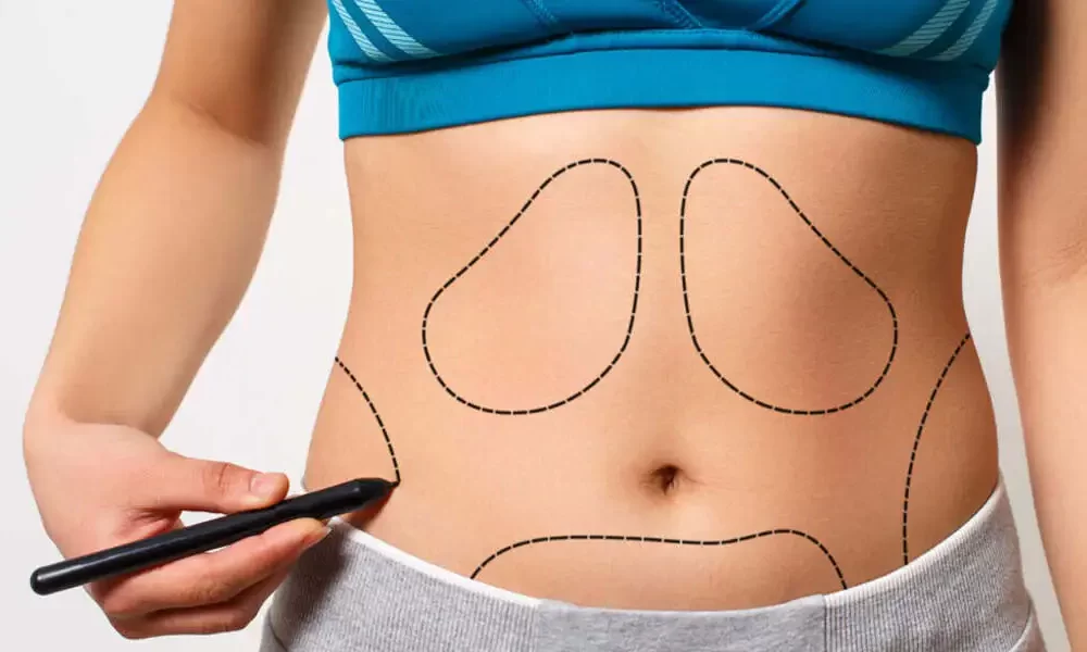 liposuction