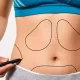 liposuction