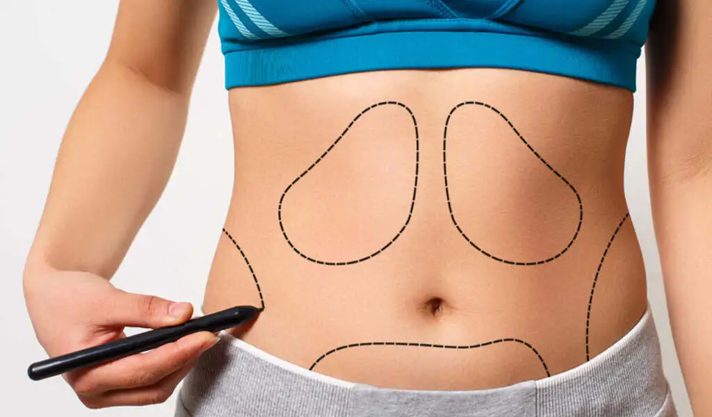 liposuction