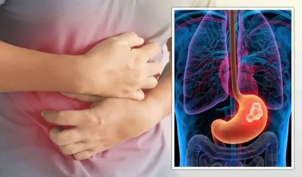 Stomach Cancer