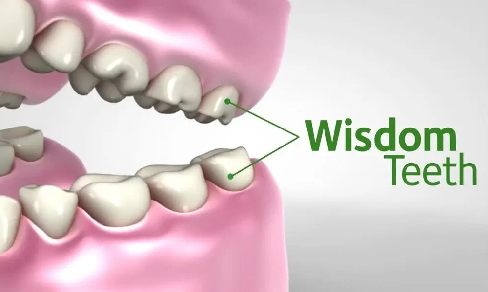 wisdom teeth