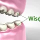 wisdom teeth