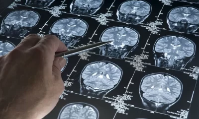 Alzheimer's