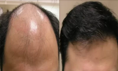Hair Loss treatment