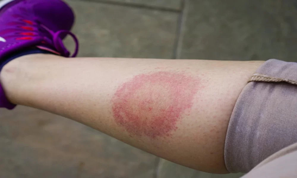 Lyme disease