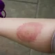 Lyme disease