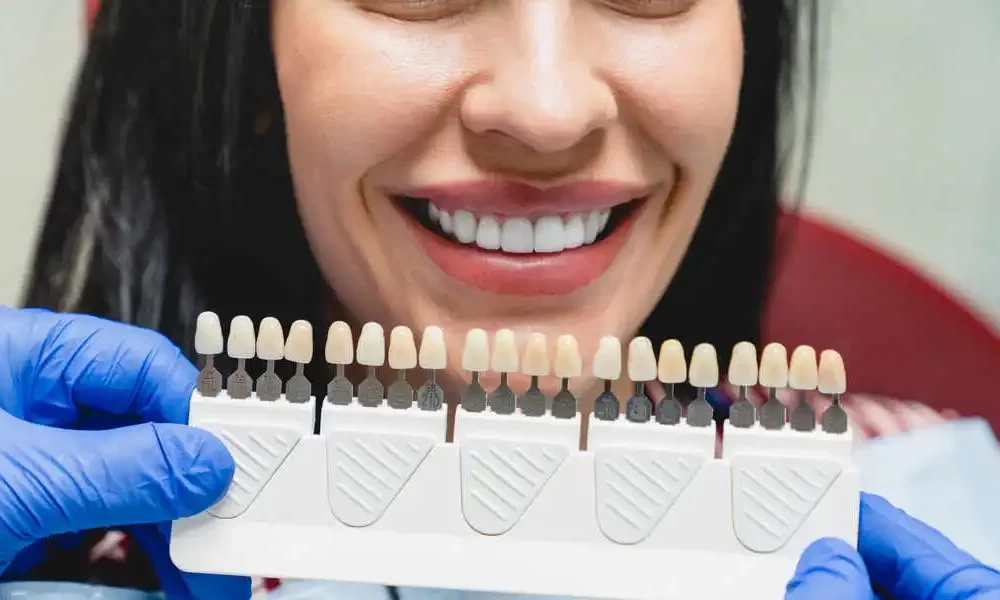 Composite Veneers