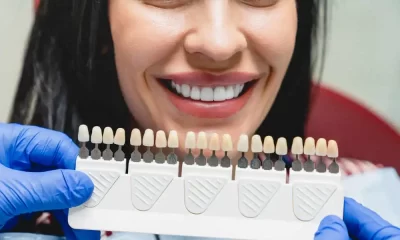 Composite Veneers