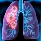 Lung Cancer: How Air Pollution Increases Cancer Risk in Lungs