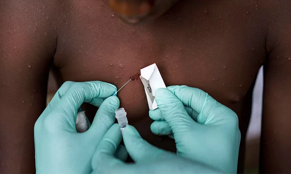 Explainer How Concerned Should We Be About Monkeypox