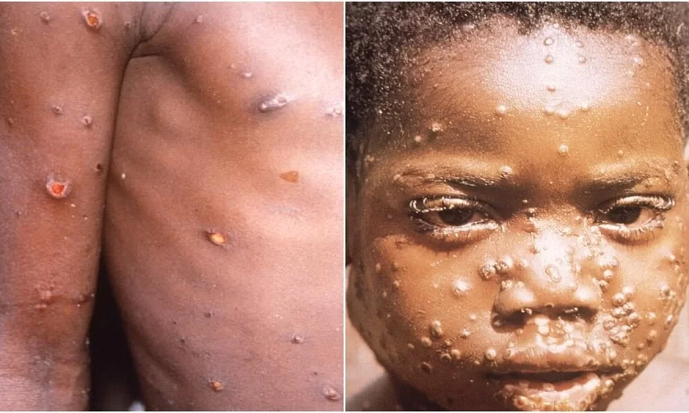 Monkeypox Which Countries Have Reported The First Monkeypox Cases