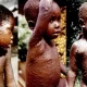 Monkeypox Virus Symptoms, Causes, Treatment, Prevention & More