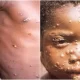 Monkeypox Which Countries Have Reported The First Monkeypox Cases