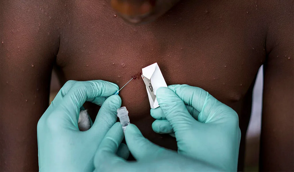 Monkeypox Can Be Contained If We Act Now, WHO Says