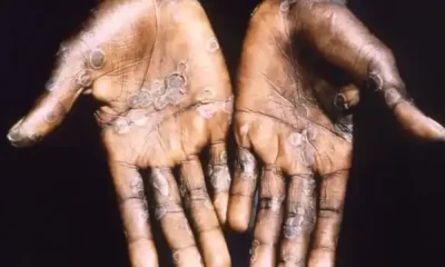 Monkeypox Outbreak WHO To Call Emergency Meeting Amid Rising Cases Across The Globe