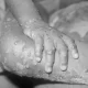 UK Stocking Up On Vaccines As Monkeypox Cases Rise To 20