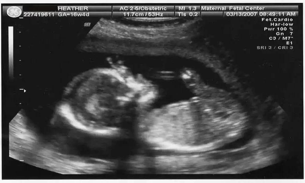 What kind of Ultrasound do they do During Pregnancy?