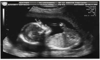 What kind of Ultrasound do they do During Pregnancy?