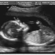 What kind of Ultrasound do they do During Pregnancy?
