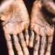 WHO Expects An Increase In Monkeypox Cases The Globally