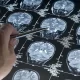 Alzheimer's Can Now Be Detected With Just One MRI Scan
