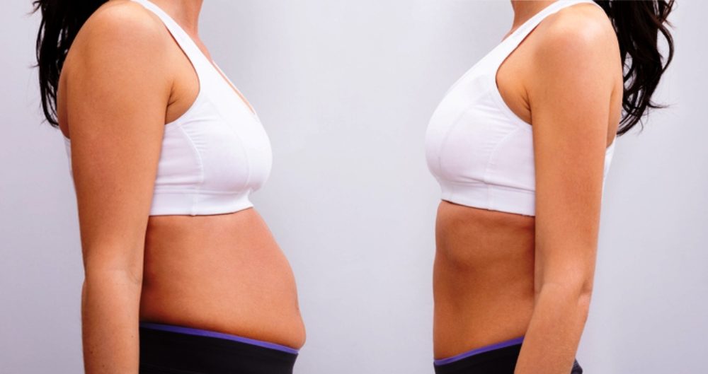 Having Liposuction and a Tummy Tuck at the Same Time