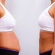 Having Liposuction and a Tummy Tuck at the Same Time