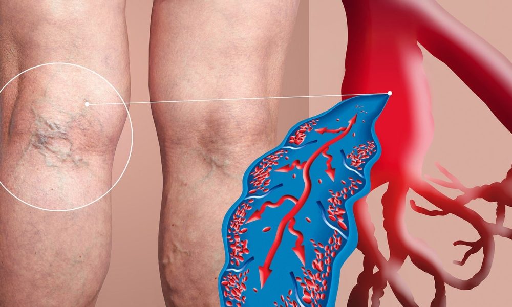 Prevent Deep Vein Thrombosis