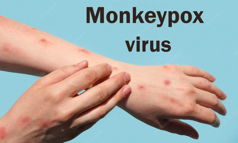 Monkeypox: WHO Calls For 'Urgent' Action