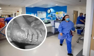 Monkeypox Cases Are Beginning To Plateau In The UK