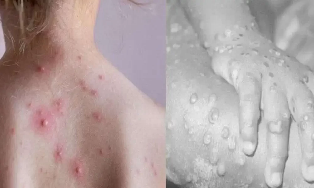Tomato flu vs Monkeypox: Symptoms, Diagnosis, Treatment, and Prevention