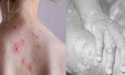 Tomato flu vs Monkeypox: Symptoms, Diagnosis, Treatment, and Prevention