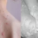 Tomato flu vs Monkeypox: Symptoms, Diagnosis, Treatment, and Prevention