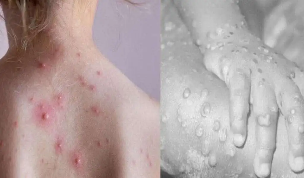 Tomato flu vs Monkeypox: Symptoms, Diagnosis, Treatment, and Prevention